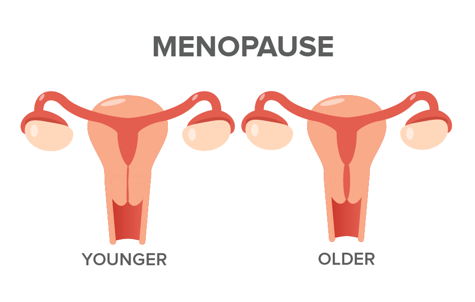 Menopause